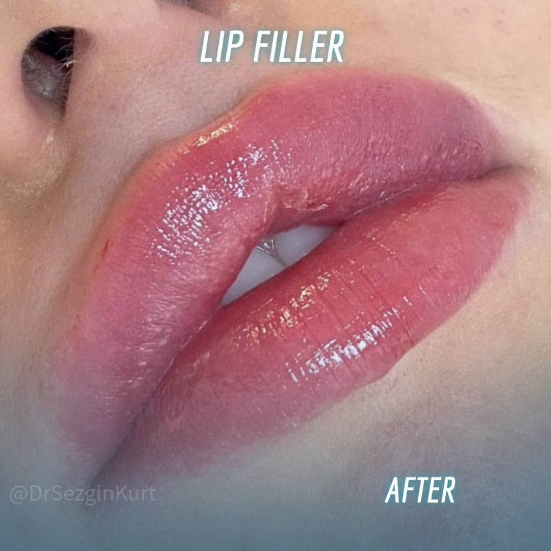 Lip Lift