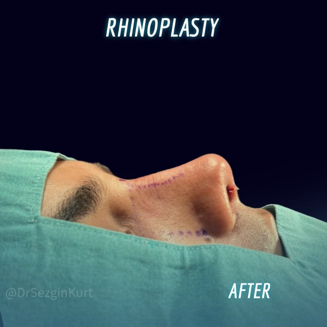 Rhinoplasty (Nose Surgery)